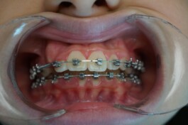 Cas clinique cabinet traitement avec brackets 1 - Découvrez nos cas cliniques en orthodontie