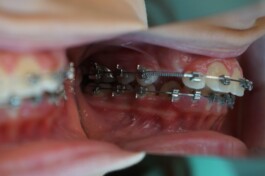Cas clinique cabinet traitement avec brackets 2 - Découvrez nos cas cliniques en orthodontie