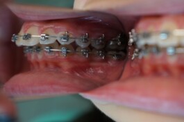 Cas clinique cabinet traitement avec brackets 3 - Découvrez nos cas cliniques en orthodontie