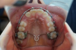 Cas clinique cabinet traitement avec brackets 4 - Découvrez nos cas cliniques en orthodontie