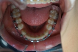 Cas clinique cabinet traitement avec brackets 5 - Découvrez nos cas cliniques en orthodontie