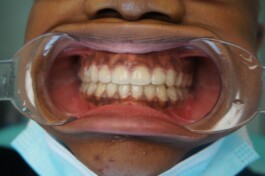 Cas clinique cabinet traitement avec gouttières - Découvrez nos cas cliniques en orthodontie 