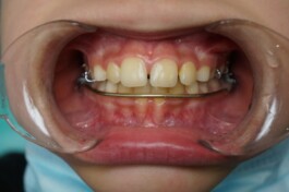 Cas clinique cabinet traitement avec plaque + LBU 1 - Découvrez nos cas cliniques en orthodontie