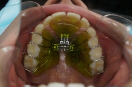 Cas clinique cabinet traitement avec plaque + LBU 2 - Découvrez nos cas cliniques en orthodontie